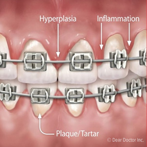 Be on the Alert for Gum Disease While Wearing Braces