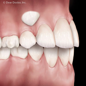 ann kearney astolfi bethlehem PA blog coaxing impacted teeth