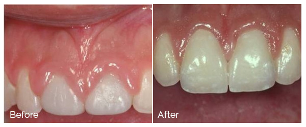 ann kearney astolfi bethlehem PA smile gallery Before and After