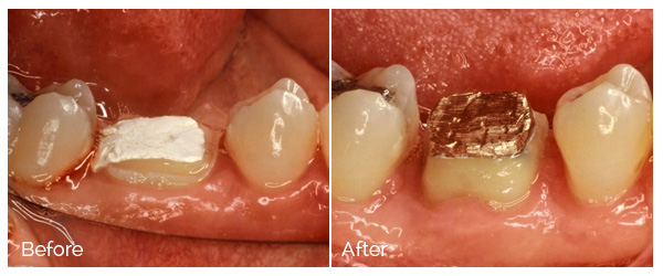 ann kearney astolfi bethlehem PA smile gallery Before and After