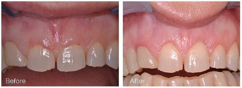ann kearney astolfi bethlehem PA smile gallery Before and After Esthetic Crown Lengthening