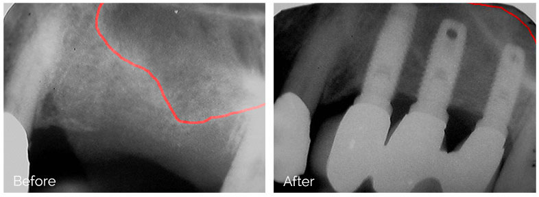 ann kearney astolfi bethlehem PA smile gallery Before and After sinus lift