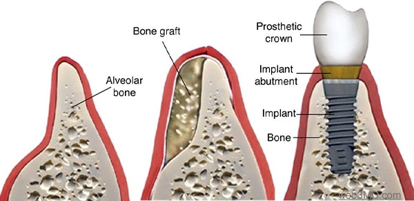 ann kearney astolfi bethlehem PA services bone grafting