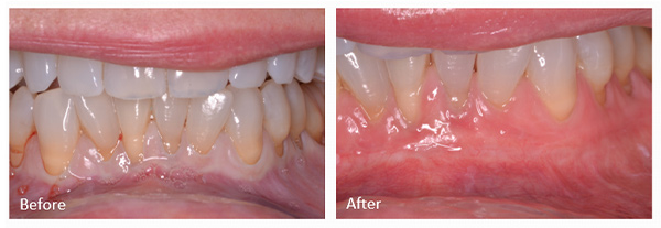 ann kearney astolfi bethlehem PA smile gallery LAPIP Before and After