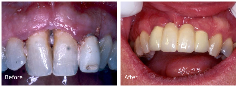 ann kearney astolfi bethlehem PA smile gallery Before and After Denta Implants